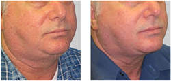 Precision Aesthetics Renews Its Commitment to Non-Surgical Body Shaping and Non- Surgical Fat Reduction with Exilis Elite